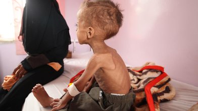 HANDOUT - ARCHIV - Ein Junge wird am 29.07.2015 in einem Krankenhaus in Sanaa (Jemen) behandelt. Wegen Mangelernährung droht knapp 1,4 Millionen Kindern in den Ländern Nigeria, Somalia, Südsudan und Jemen nach Unicef-Angaben der Hungertod. (zu dpa «U